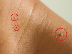 Warts Removal Tips: పులిపిరులు వేదిస్తున్నాయా? ఈ ఆయుర్వేద చిట్కా పాటిస్తే వెంటనే రాలిపోతాయి