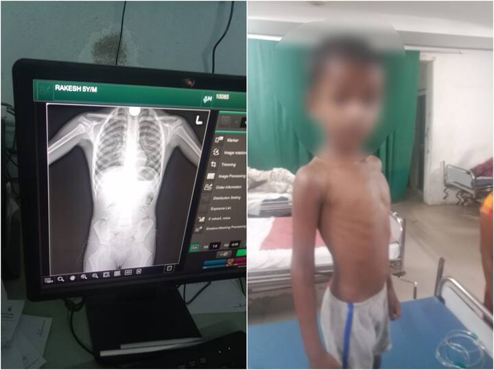 Chittoor Boy swallows five rupees coin govt hospital doctors negligence in treatment Chittoor News : రూ. ఐదు నాణెం మింగేసిన బాలుడు, తల్లిదండ్రులకు వైద్యుల నిర్లక్ష్య సలహా!
