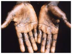 Monkeypox Outbreak | More Than 20 Nations Report 200 Cases; Spread Containable: WHO