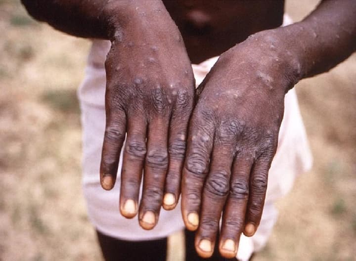 Doctors advice if rashes on Skin in one to three days of fever it could be Monkeypox Virus Doctors on Monkeypox: बुखार है और एक से तीन में दिन चकत्ते पड़ जाएं तो यह मंकीपॉक्स हो सकता है