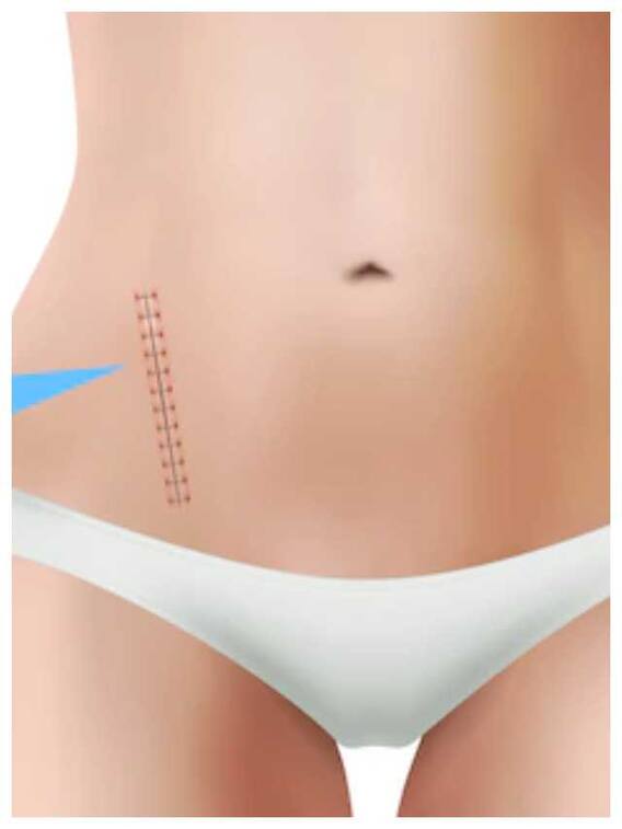 टांके के निशान को कैसे करें कम?