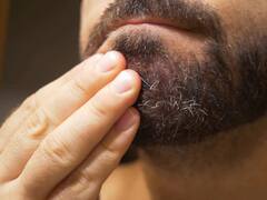 Folliculitis Remedies: बालतोड़ की परेशानी को करना है दूर, अपनाएं ये असरदार घरेलू उपाय