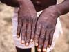 Guidelines for Monkeypox: মাঙ্কিপক্স রুখতে আগেভাগেই কড়া কেন্দ্র, জারি গাইডলাইনও