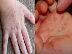 Tomato Flu: बच्चों पर मंडराया टोमैटो फ्लू का खतरा, जानें कारण, लक्षण और इलाज