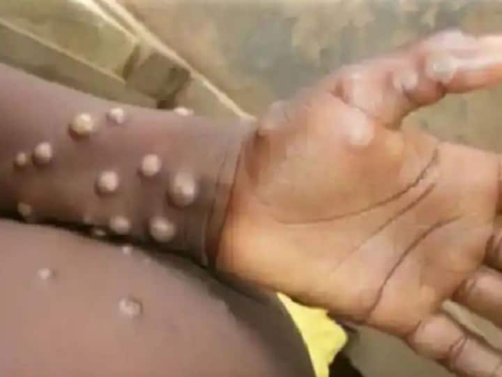 Monkeypox Virus Suspected Case in UPs Ghaziabad Has Tested Negative Monkeypox Case in Ghaziabad: गाजियाबाद की 5 साल की बच्ची में दिखे थे मंकीपॉक्स के लक्षण, अब रिपोर्ट आई नेगेटिव