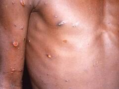 Monkeypox Virus: பரவும் குரங்கு அம்மை: உடனே இதை செய்யுங்க...! விமான நிலையங்களுக்கு சுகாதாரத்துறை அவசர உத்தரவு..