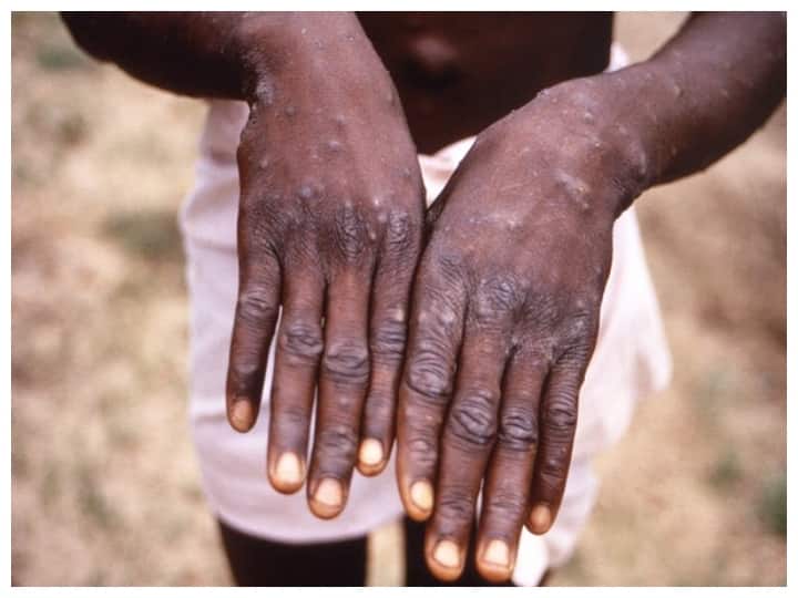 Britain Monkeypox Outbreak Spreading England Mostly In Young Men In London