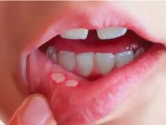 Health Tips : वारंवार तोंडात अल्सर येताहेत? मग हे घरगुती उपाय करुन बघा