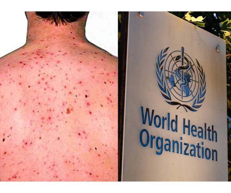 monkeypox virus No need to declare as global health emergency says WHO MonkeyPox: मंकीपॉक्स पर WHO का बड़ा बयान, वायरस को अभी ग्लोबल हेल्थ इमरजेंसी घोषित करने जरूरत नहीं