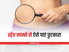 Home Remedies for Stretch Marks: इन घरेलू उपाय को अपनाकर स्ट्रेच मार्क्स से पा सकते हैं छुटकारा, दिखेगा तुरंत रिजल्ट