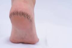 Cracked Heels: એડીના ચીરાથી પરેશાન છો? અપનાવો આ અસરદાર ઘરેલુ નુસખા