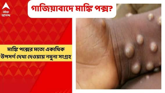 Monkeypox virus: গাজিয়াবাদে মাঙ্কি পক্স হানা? ৫ বছরের বালিকার নমুনা সংগ্রহ