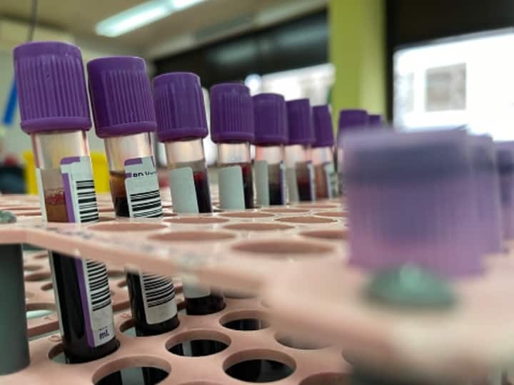 Uttar Pradesh: Sample Of 5-Year-Old Collected For Monkeypox Testing As 'Precautionary Measure' Uttar Pradesh: Sample Of 5-Year-Old Collected For Monkeypox Testing As 'Precautionary Measure'