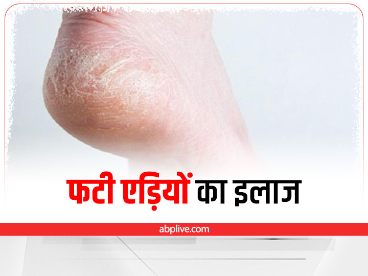 Crack heels discount solution in hindi