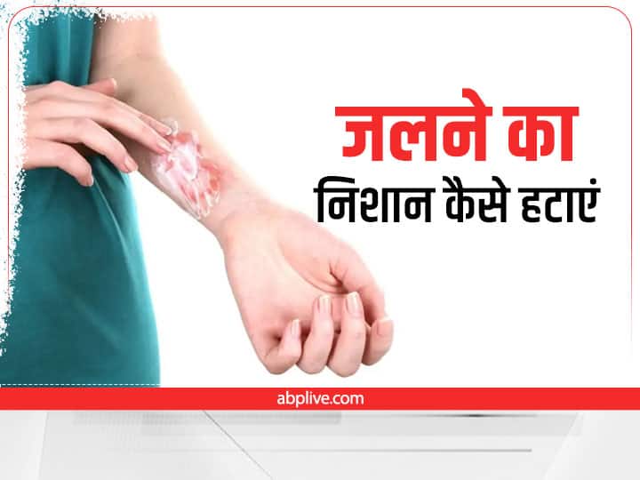 How To Remove Burn Marks Home Remedy How To Fade Burn Scars Health Tips: जलने का निशान तुरंत हो जाएगा गायब, अपनाएं ये उपाय