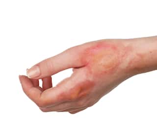 Health Tips : त्वचेवरील जळलेल्या खुणा दूर करायच्या आहेत, करा 'हे' उपाय