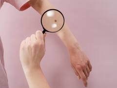 Skin Cancer Symptoms: మీ శరీరంపై ఇలాంటి మచ్చలు ఉన్నాయా? జాగ్రత్త, చర్మ క్యాన్సర్ కావచ్చు!