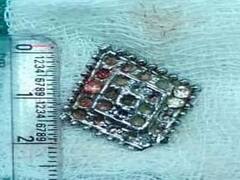 தொண்டையில் சிக்கிய உலோக டாலர்: அறுவை சிகிச்சையால் பிழைத்த குழந்தை - முதல்வர் திட்டத்தால் கிடைத்த உதவி!