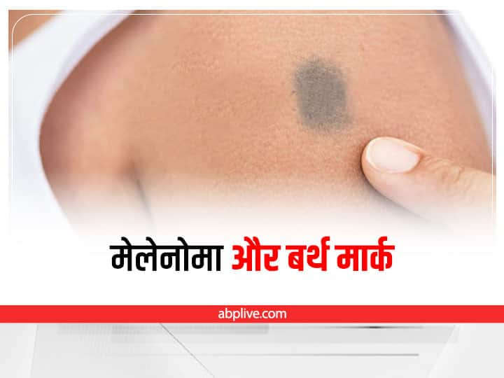 cause of melanoma how it develop in birthmarks and when to see the doctors Birthmarks: मेलेनोमा में भी बदल सकता है आपका बर्थमार्क, इन तरीकों से करें जांच