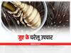 Lice on Hair : सिर के जुएं से हैं परेशान? अपनाएं ये आसान से घरेलू उपाय