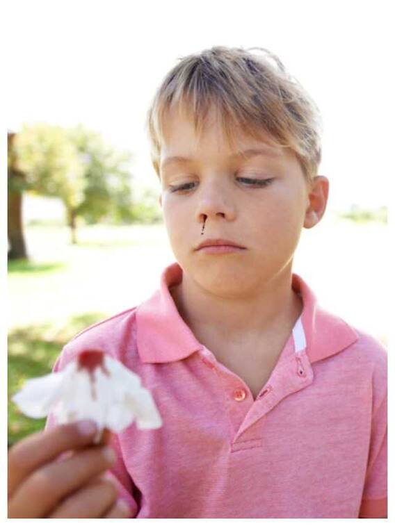 नकसीर के घरेलू उपाय