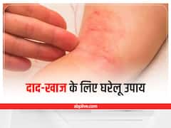 Ringworm  Remedies: बरसात में हो सकती है दाद-खाज की समस्या, इन तरीकों से पाएं निजात