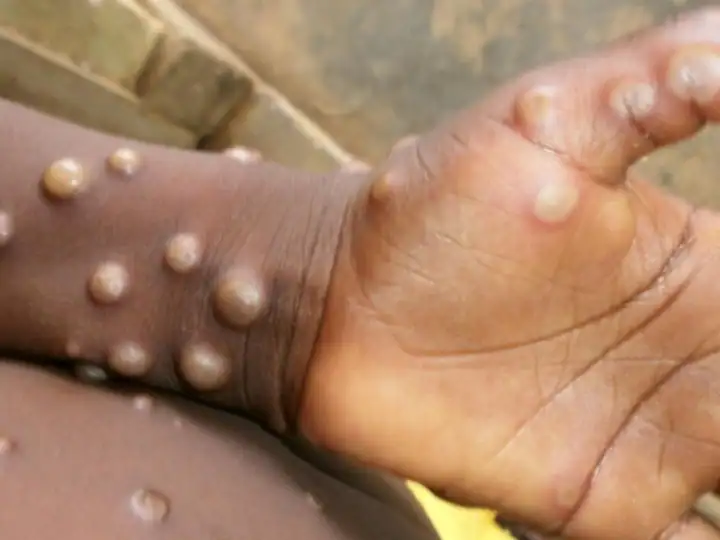 Can monkeypox be spread between humans Monkeypox : મંકીપોક્સ કોરોનાની જેમ જ વ્યક્તિથી વ્યક્તિમાં ફેલાય છે