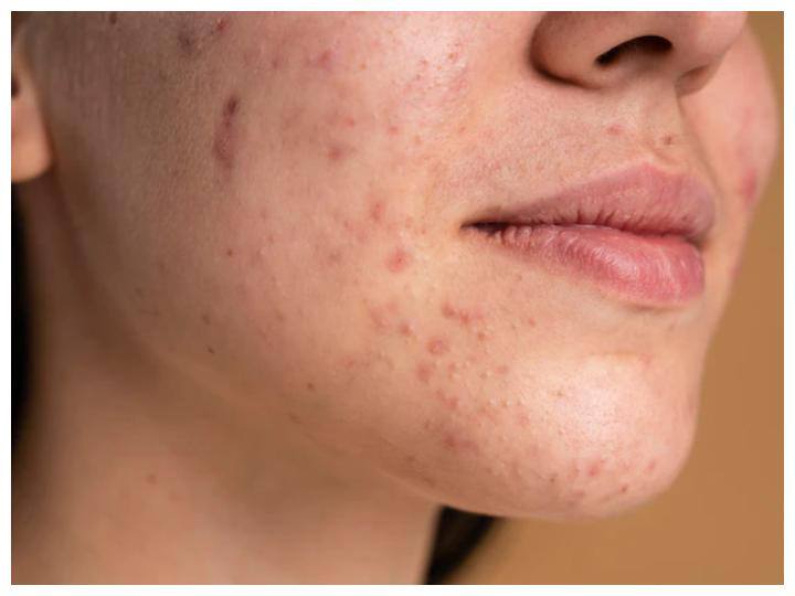 त्वचा संक्रमण के लिए: नीम के एंटी बैक्टीरियल और एंटी फंगल गुण आपकी त्वचा की रक्षा करते हैं. नीम की पत्त्तियों को पीसकर इसे चेहरे पर लगाएं और सूखने के बाद गुनगुने पानी से धो लें.