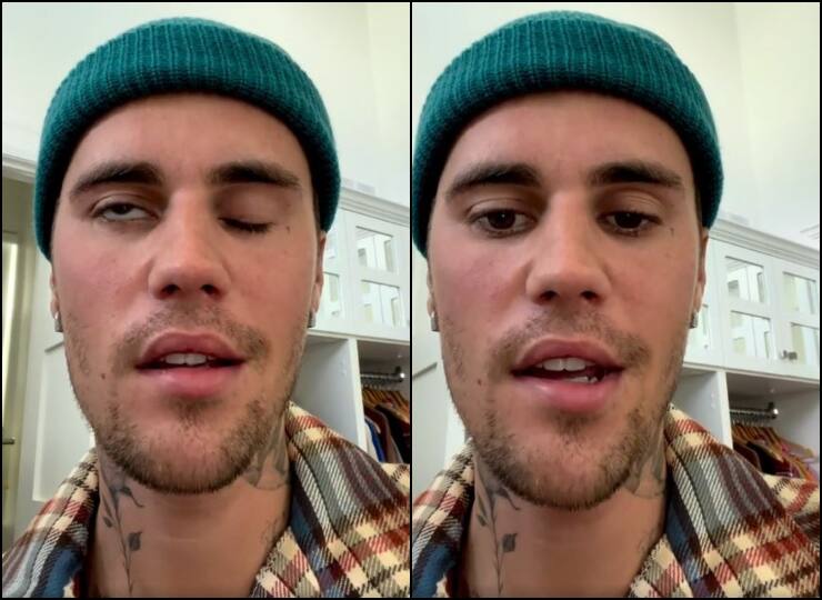 જાણો શું છે રામસે હંટ સિંડ્રોમના લક્ષણો અને કારણો જેનાથી જસ્ટિન બીબરનો ચહેરો લકવાગ્રસ્ત થયો symptoms and causes of Ramsay Hunt Syndrome that paralyzed Justin Bieber's face. જાણો શું છે રામસે હંટ સિંડ્રોમના લક્ષણો અને કારણો જેનાથી જસ્ટિન બીબરનો ચહેરો લકવાગ્રસ્ત થયો