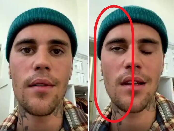 Justin Bieber suffers from facial paralysis due to Ramsay Hunt syndrome, what is it? Justin Bieber: జస్టిన్ బీబర్‌కు ముఖ పక్షవాతం, ‘రామ్సే హంట్’ వ్యాధి మీకూ రావచ్చు, లక్షణాలివే!