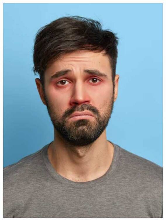 आंखों की सूजन कैसे करें कम