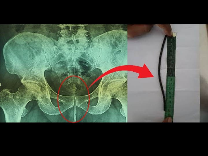 Pakistani man puts 7 inch long electric wire inside penis to help him urinate Viral News: डॉक्टरही हैराण! लघवी करताना त्रास म्हणून या व्यक्तीने थेट...
