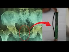 Viral News: डॉक्टरही हैराण! लघवी करताना त्रास म्हणून या व्यक्तीने थेट...