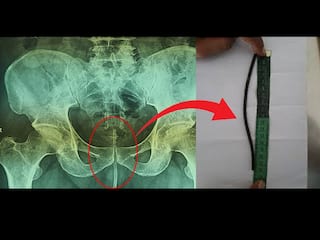 Viral News: डॉक्टरही हैराण! लघवी करताना त्रास म्हणून या व्यक्तीने थेट...