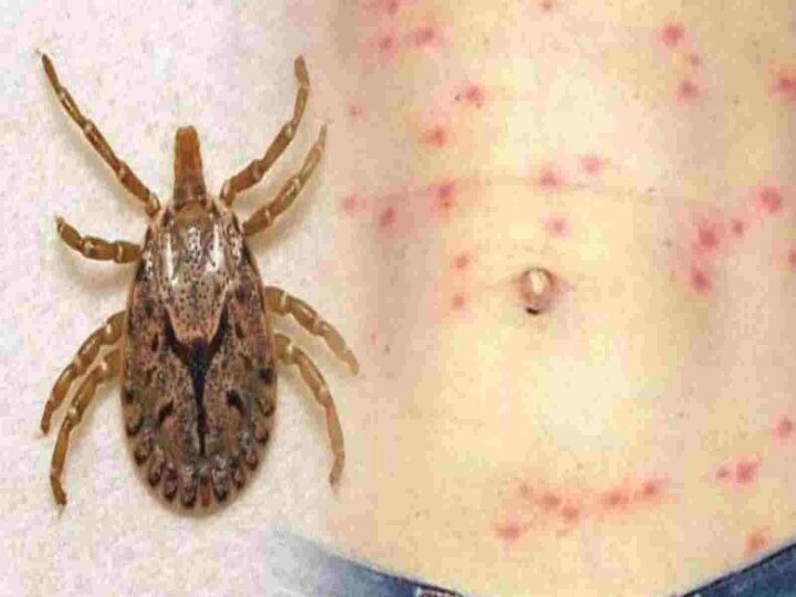 Scrub Typhus : அடுத்த அச்சுறுத்தல்.. 3 நாட்களில் இரண்டாவது மரணம்.. அதிரவைக்கும் ஸ்க்ரப் டைஃபஸ் தொற்று