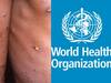 WHO on Monkeypox: கொரோனாவுக்கு அடுத்து மீண்டும் சுகாதார அவசரநிலை? குரங்கு அம்மை குறித்து WHO ஆலோசனை