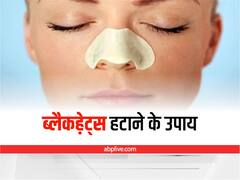 Blackheads on Nose: नाक के ब्लैकहेड्स से बिगड़ सकती है खूबसूरती, इन घरेलू उपायों से पाएं छुटकारा