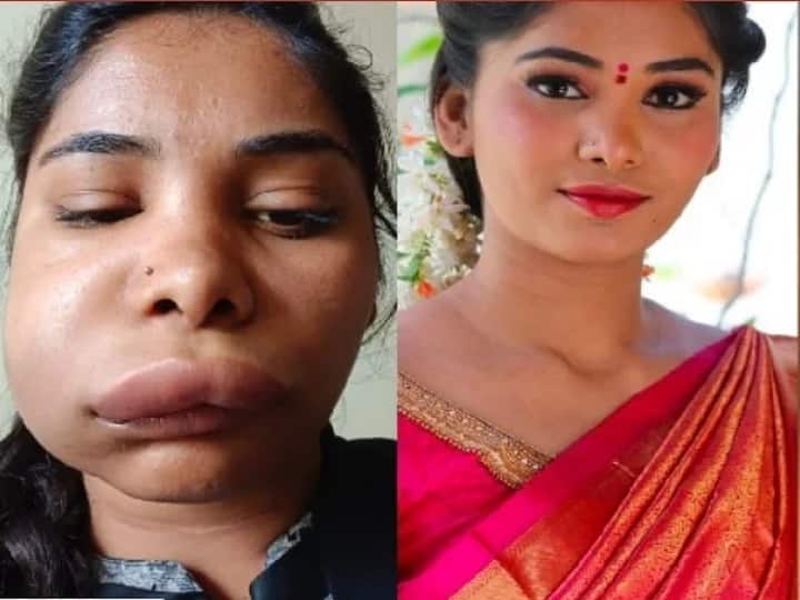 kannada actress swathi sathis dental treatment goes wrong பல் சிகிச்சைக்காக  ஊசி! பரிதாபமாக மாறிய முகம் ! குறையாத வீக்கத்தால் குமுறிய நடிகை!
