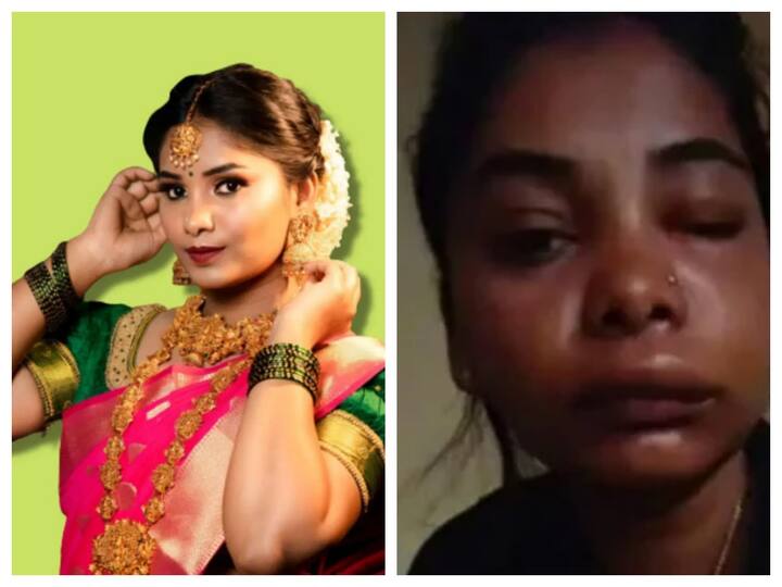 Kannada actress Swathi Sathish's root canal surgery goes horribly wrong, left with swollen face Swathi Sathish: వికటించిన సర్జరీ - గుర్తుపట్టలేని విధంగా మారిపోయిన హీరోయిన్!