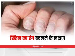 Diabetes Symptoms: स्किन का बदलता रंग, हो सकता है डायबिटीज का लक्षण
