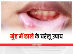Mouth Ulcer: मुंह के छालों को दूर करने के लिए अपनाएं ये टिप्स