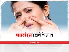 Whiteheads Remedies : स्किन की खूबसूरती बिगाड़ सकते हैं व्हाइटहेड्स, इन उपायों से करें दूर