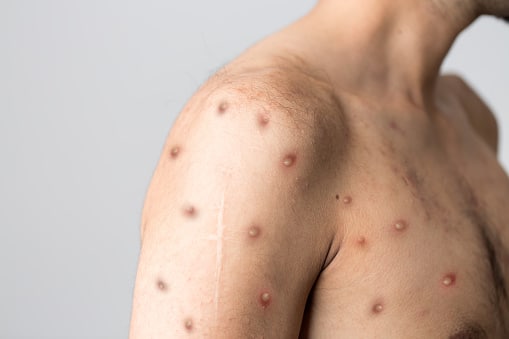 Monkeypox Case In India Know from Expert symptoms and prevention of monkeypox virus Monkeypox Virus: क्या हैं मंकीपॉक्स के लक्षण और कैसे कर सकते हैं इससे बचाव? जानिए एक्सपर्ट से