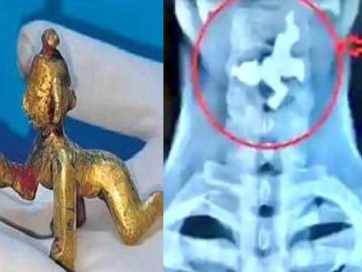 Doctors remove Krishna idol from Karnataka man’s throat after he accidentally swallows it ஒரே மடக்காக தீர்த்தம் குடித்த பக்தர்! தொண்டையில் சிக்கிய கிருஷ்ணர் சிலை!