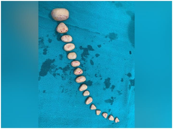 Delhi ISIC Doctors removed 16 stones from paralyzed mans Urinary Bladder Stones In Bladder: डॉक्टरों ने सर्जरी कर लकवाग्रस्त मरीज के यूरिनरी ब्लैडर से निकाले 16 पत्थर, मिली नई जिंदगी