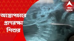 SSKM : এসএসকেএমে জটিল অস্ত্রোপচার, দেড় বছরের শিশুর গলা থেকে বের হল দারুচিনি