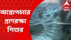 SSKM Operation: SSKM হাসপাতালে জটিল অস্ত্রোপচার, দেড় বছরের শিশুর গলা থেকে বের হল দারুচিনি