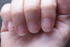 Dry Cuticle Problem: নখের পাশে চামড়া উঠলে দ্রুত যা করবেন