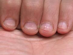 Dry Cuticle Problem: নখের পাশে চামড়া উঠলে দ্রুত যা করবেন