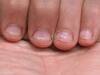 Dry Cuticle Problem: নখের পাশে চামড়া উঠলে দ্রুত যা করবেন